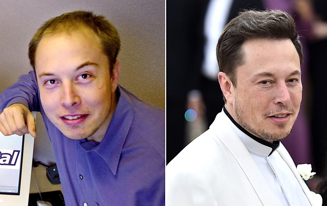 Elon Musk, avant et après sa greffe cheveux