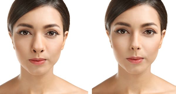 Gonflement ou grossissement nez après rhinoplastie