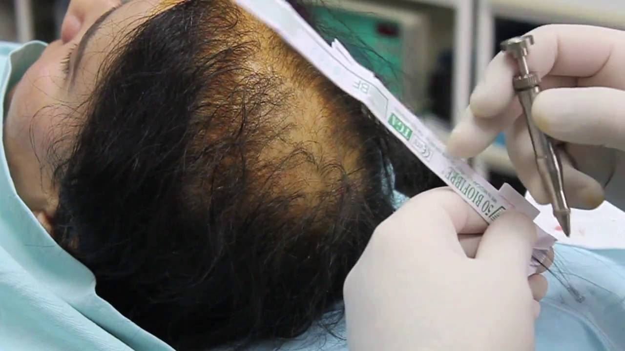 Biofibre, la nouvelle technique pour traiter la chute des cheveux en Turquie !