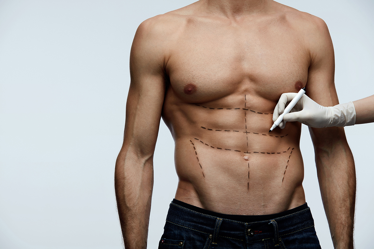 Abdominal etching en Turquie : toutes les informations sur cette chirurgie esthétique du ventre