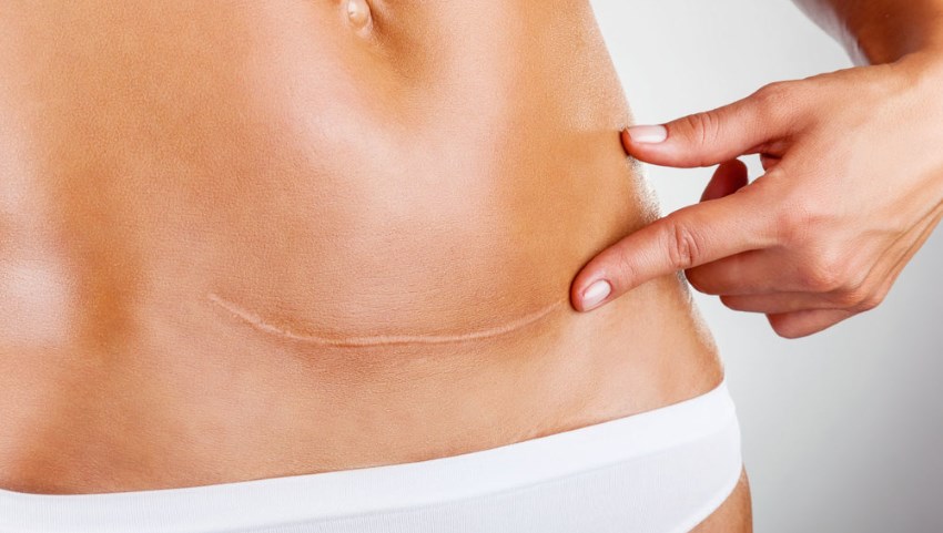 Que faire après une abdominoplastie ratée ?