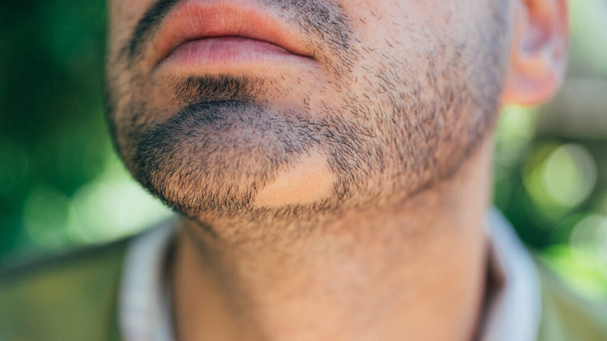 Pelade de la barbe : causes, traitements et repousse capillaire