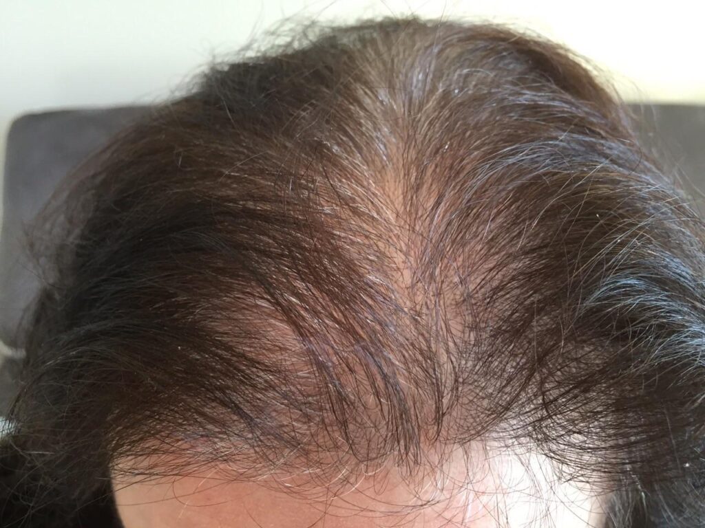 Combien une femme perdelle de cheveux par jour