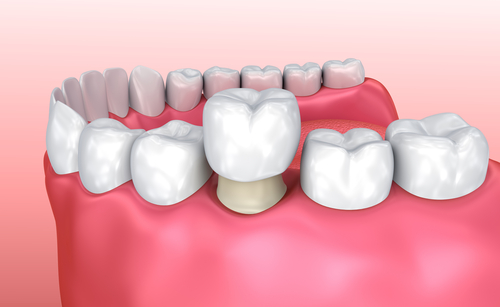 couronne-dentaire-qui-bouge