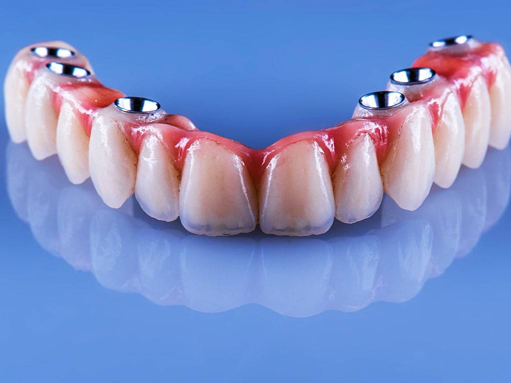 Comment refaire toutes ses dents en une seule fois ?