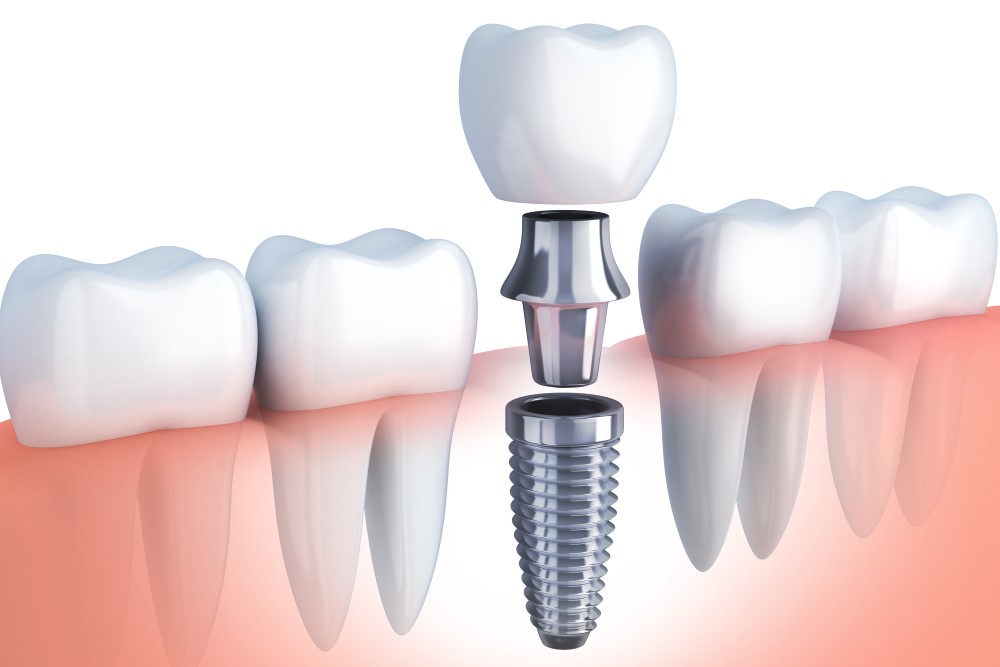 Quels sont les effets secondaires des implants dentaires ?