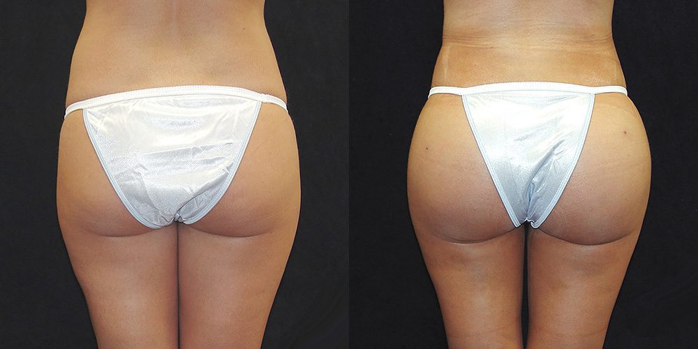 Extensive Comparison of Brazilian Butt Lift (BBL) Procedure Costs: Sheffield vs Kahramanmaraş