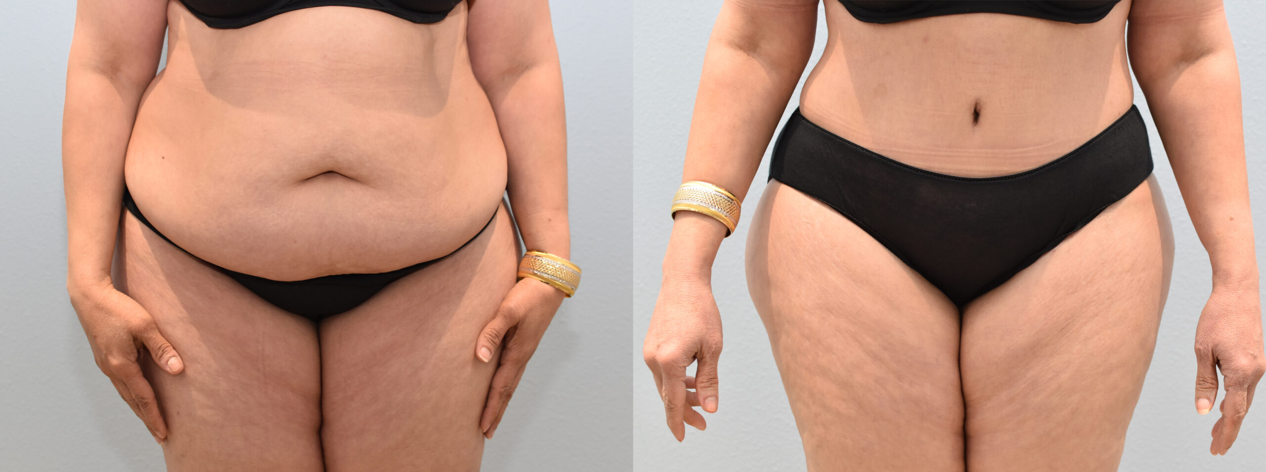 Comprehensive Comparison: Tummy Tuck Procedure in Leeds vs. Turkey