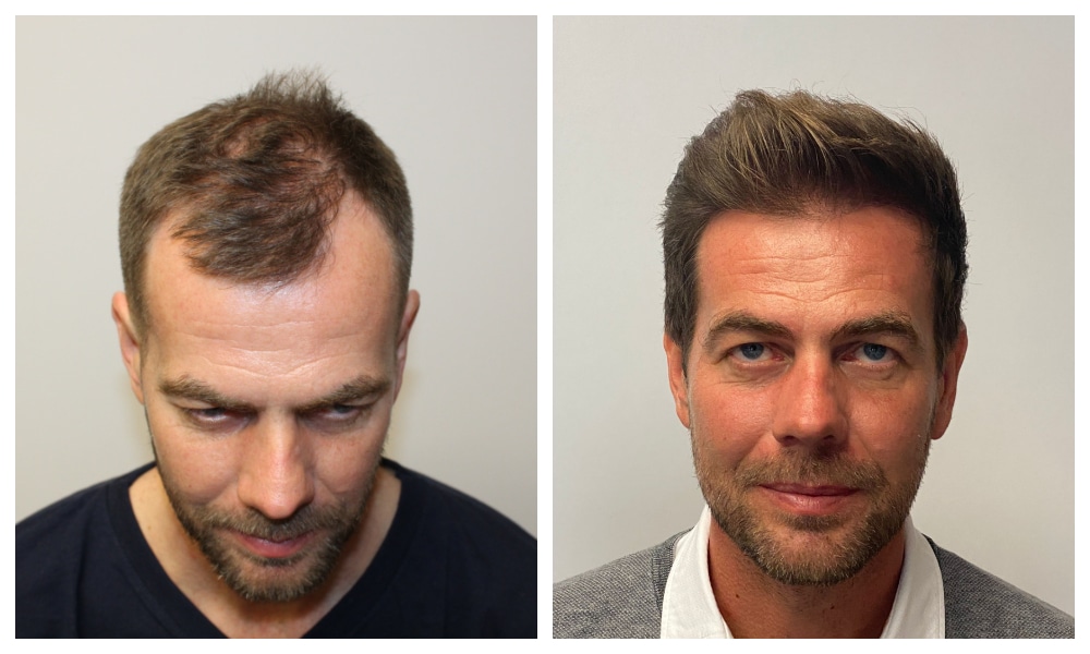 Hair Transplant Procedures: A Comprehensive Comparison Between Westminster and Turkey
