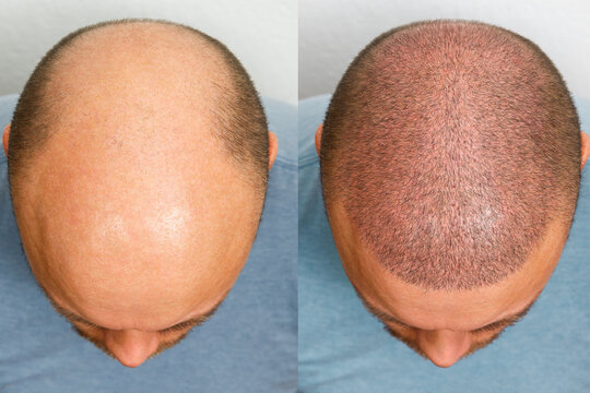 Comprehensive Comparison of Hair Transplant Procedure Costs: Qatar vs. Turkey