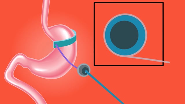 Understanding Gastric Band Procedure Costs in Turkey