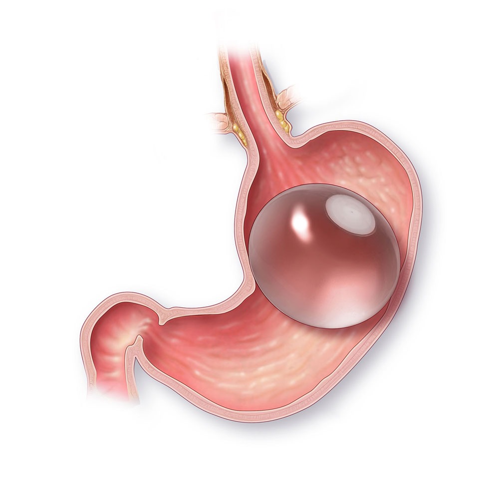Gastric Balloon Procedure Cost Comparison: Qatar vs Turkey