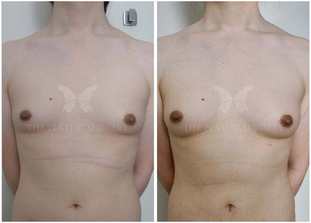 Comprehensive Comparison of Breast Lipofilling Procedures in Sunderland vs Izmir