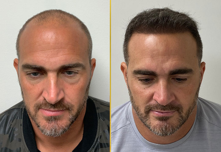 Comprehensive Guide to DHI Hair Transplant Prices in Turkey: Costs, Factors, and Considerations
