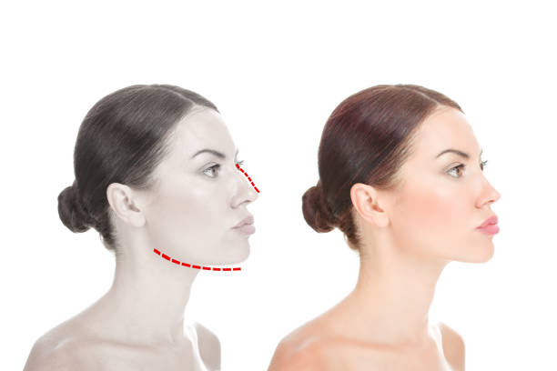 Comprehensive Comparison: Chin Augmentation Costs in the UAE vs. Turkey