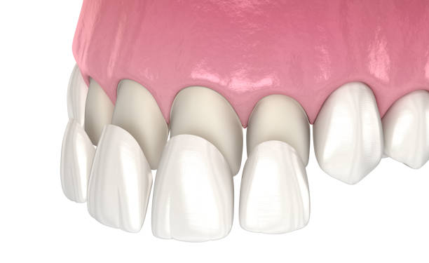 In-Depth Analysis of Dental Veneers Procedure Costs in Edinburgh vs Adapazarı