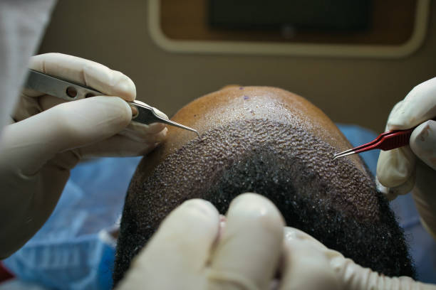 The Comprehensive Guide to FUT Hair Transplant Prices in Turkey