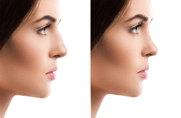 In-Depth Comparison of Nose Job Prices: Bahrain vs Turkey