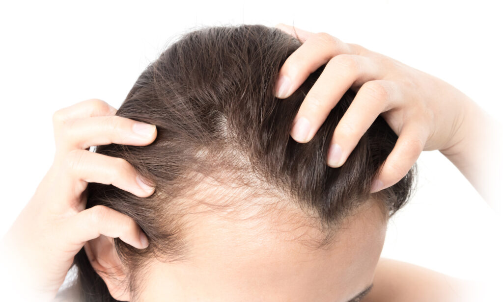 The Ultimate Guide to the Cost of FUE Hair Transplant in Turkey