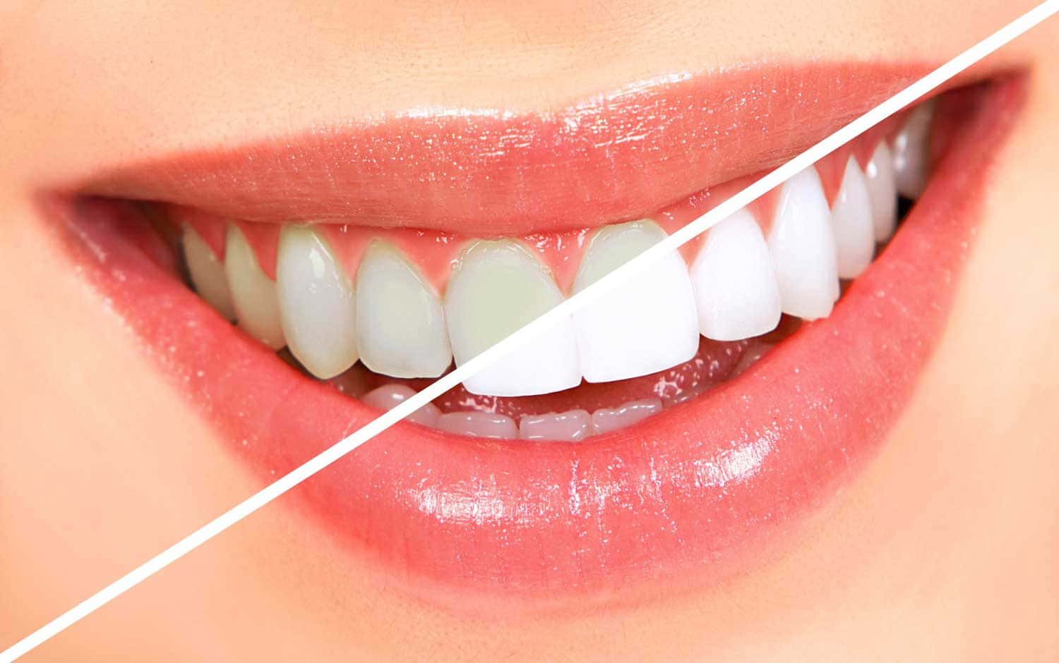 In-Depth Analysis of Teeth Whitening Costs: Bradford vs. Malatya