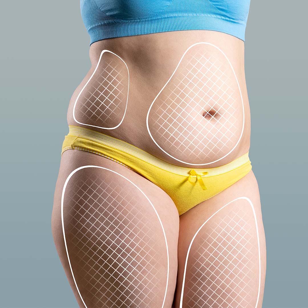 Comprehensive Guide to 360 Body Lift Procedure Costs in Turkey: Everything You Need to Know