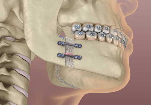 The Ultimate Guide to Orthodontic Surgery Costs in Turkey