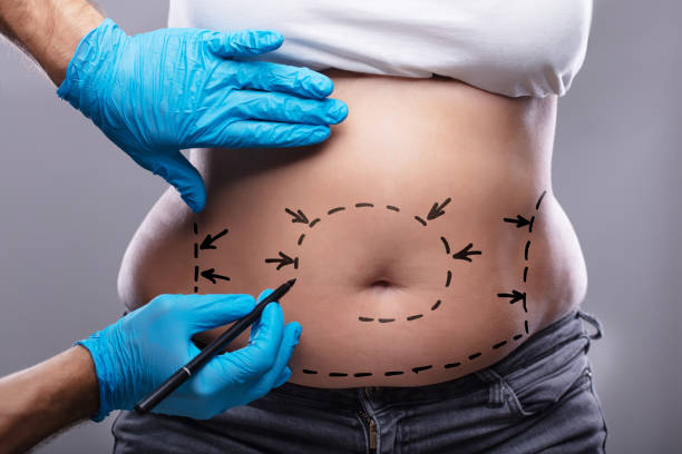 In-Depth Analysis of the Cost of Cosmetic Belly Surgery in Turkey
