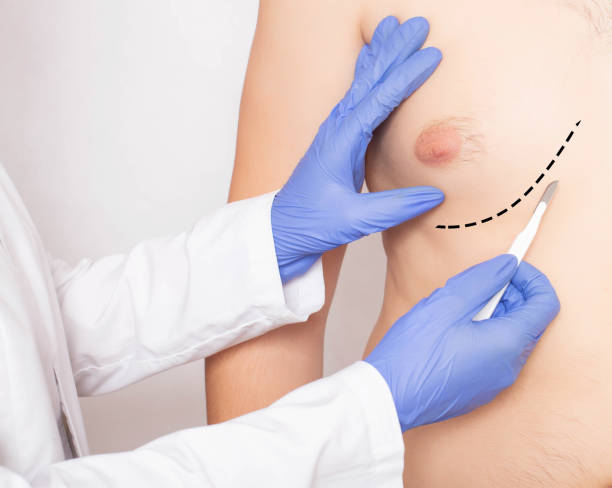 Comprehensive Guide to the Cost of Gynecomastia Surgery in Turkey: Everything You Need to Know