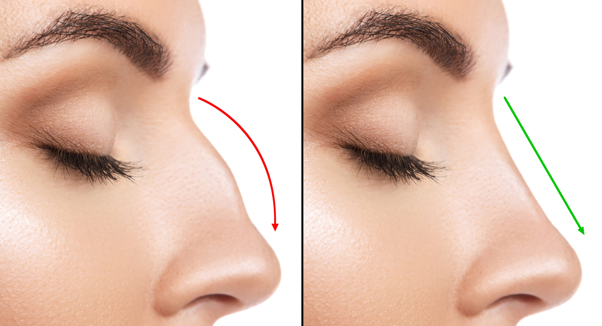 Comprehensive Guide to Hump Removal Nose Surgery in Turkey: Costs and Considerations