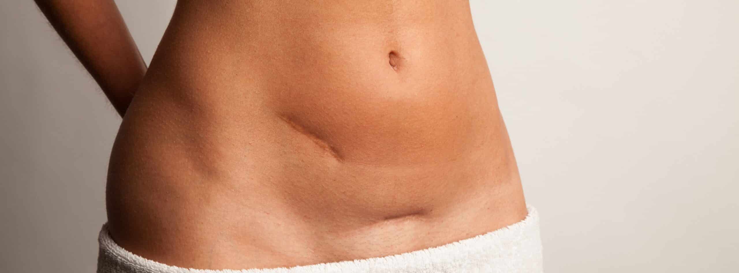 UrgoTouch : La Technologie Laser Révolutionnaire pour des Cicatrices Plus Discrètes et Esthétiques