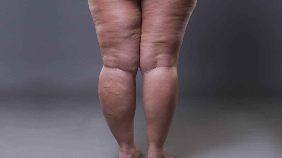 Éliminer le lipœdème par liposuccion WAL : la technique innovante en Tunisie