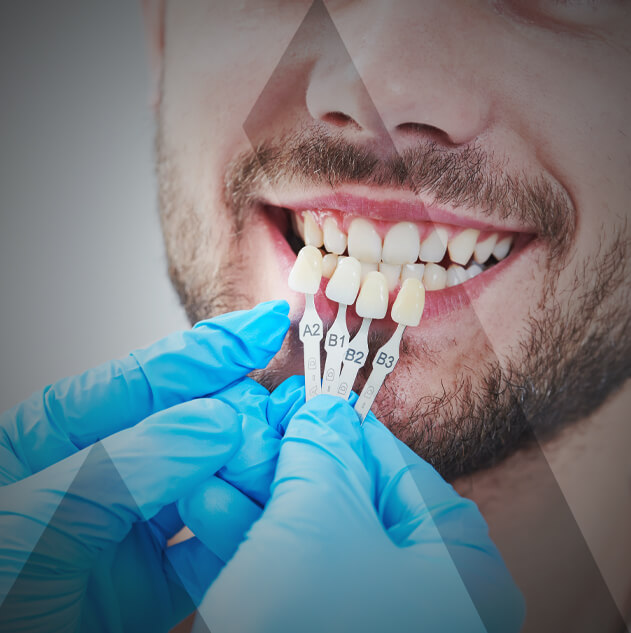 dental-veneers-turkey