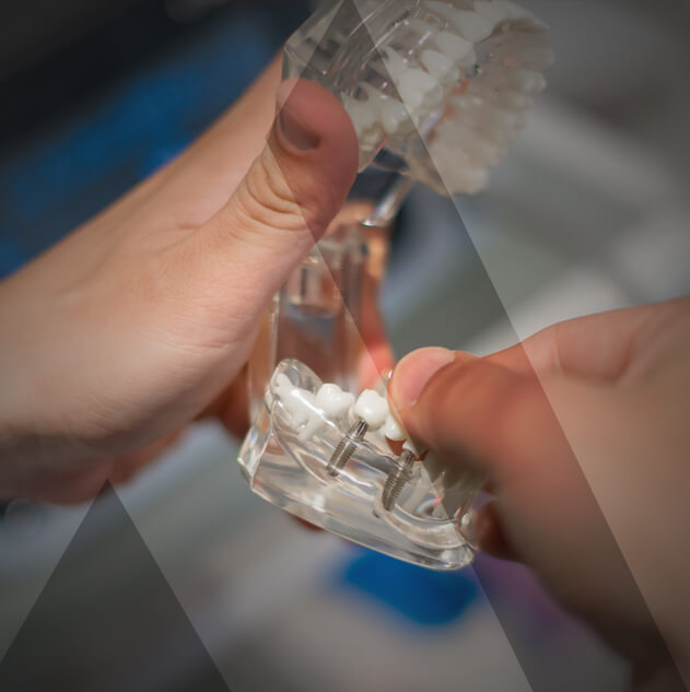 dental-implants-procedure