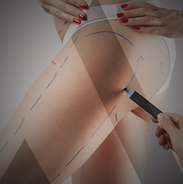 thigh-lift-Turkey