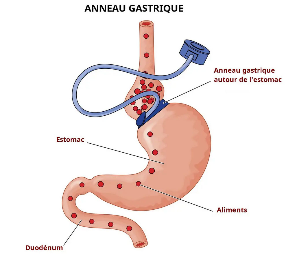 anneau-gastrique