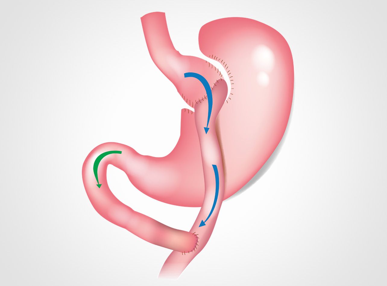 bypass-gastrique