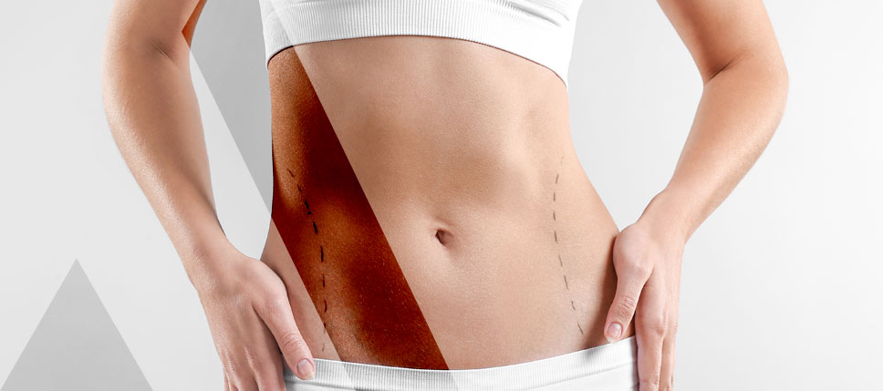 chirurgie ventre plat