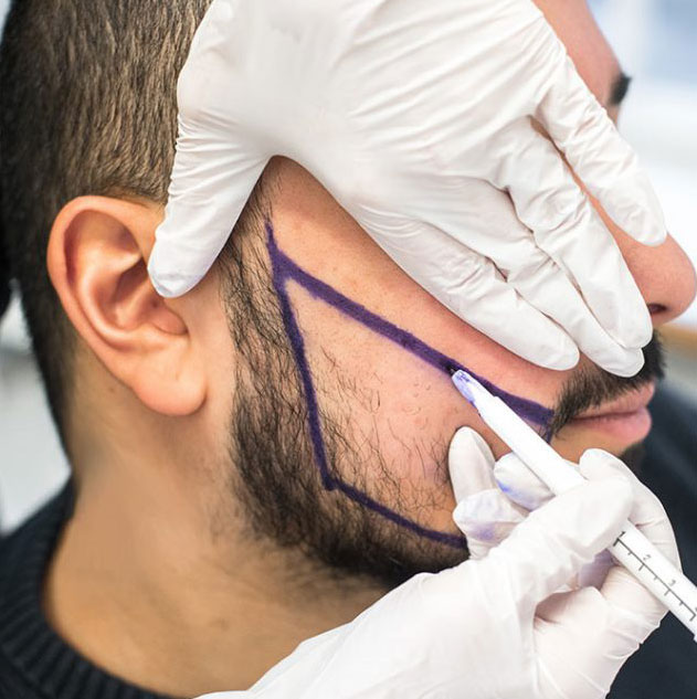alopecie-barbe