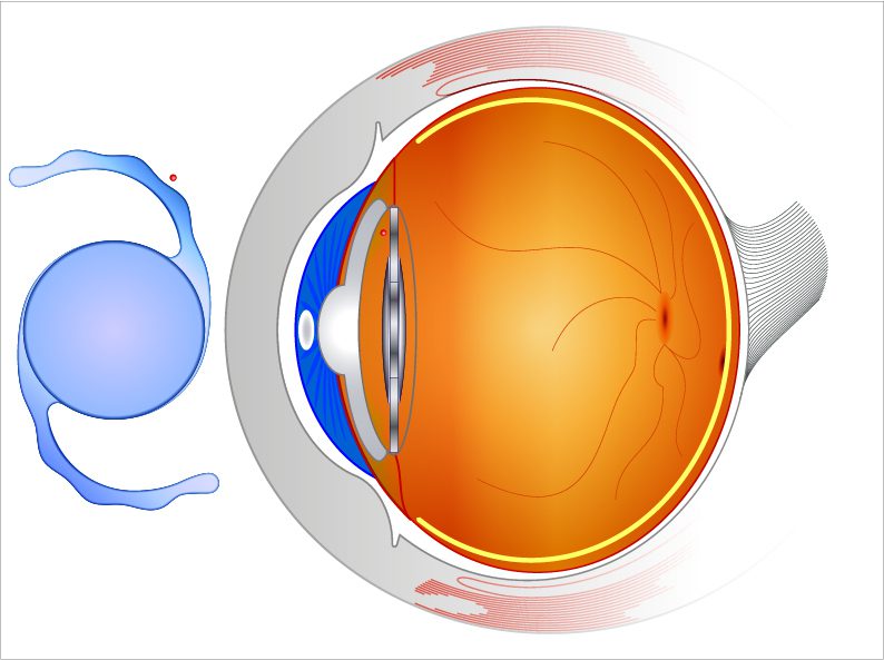 lentille-intraoculaire