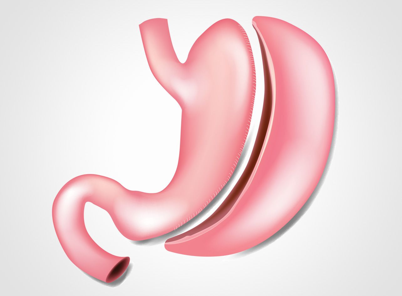 sleeve-gastrique